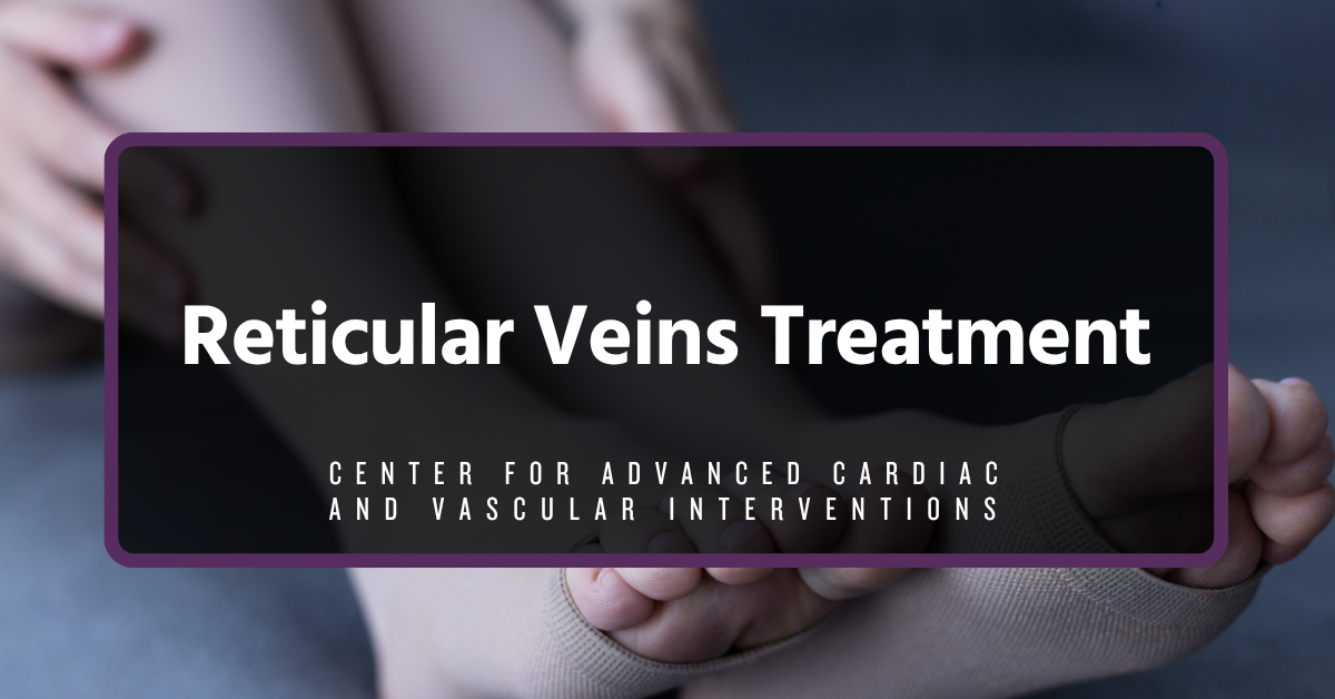 Reticular Veins Treatment Reticular veins visible under skin on legs before treatment