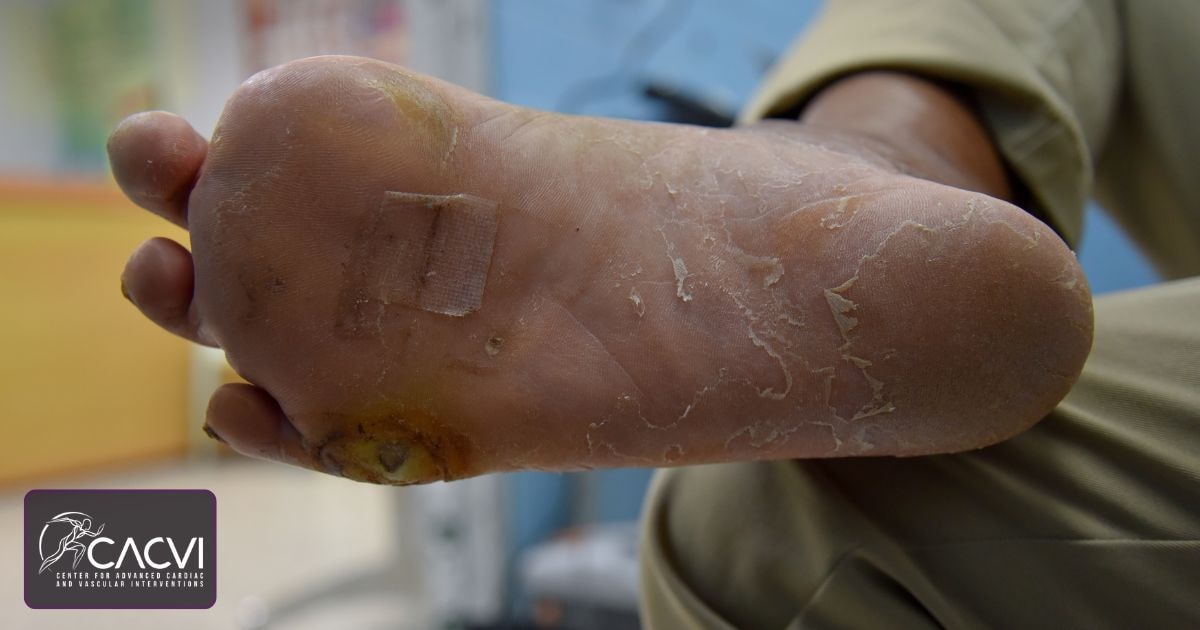 What Conditions Require Limb Salvage Surgery?